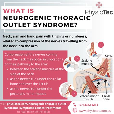 Neurogenic Thoracic Outlet Syndrome: Symptoms, Causes, Treatments