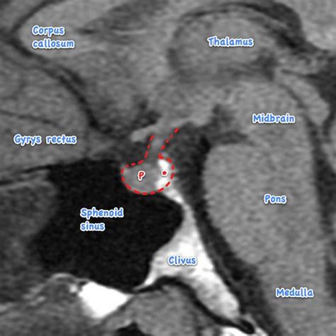 Pituitary MRI - normal study | Radiology Case | Radiopaedia.org | Radiology, Radiology imaging, Mri