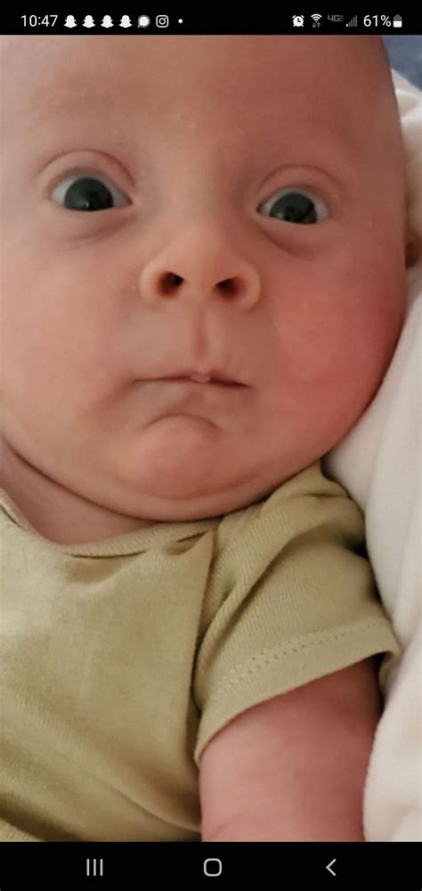 Hydrocephalus - sunset eyes | BabyCenter