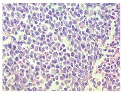 Atypical Teratoid/Rhabdoid Tumor with Retained SMARCB1 (INI1) Expression and Rare SMARCA4 Gene ...