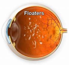 mosche volanti cure miodesopsie floaters mosche volanti mosche volanti cure miodesopsie floaters mosche volanti