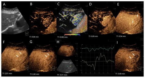 Washout on Contrast-Enhanced Ultrasound of Benign Focal Liver Lesions—A Review on Its Frequency ...