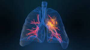 Life and Breath – Outliving Lung Cancer