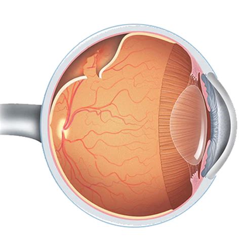 What are the common diseases that have an impact on the Retina? | Dr ...