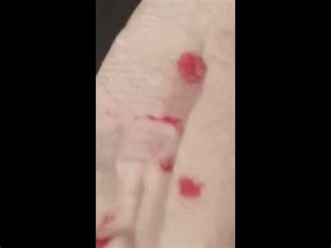 Largest Exploding Cyst 的图像结果