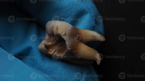 Decayed Tooth Pulling 的图像结果