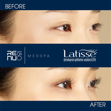 Latisse Before And After Eyebrows