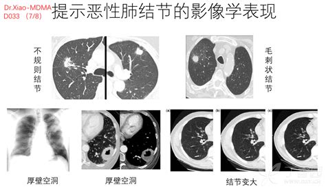 肺癌筛查/肺结节/肺癌临床决策思维导图（Dr. Xiao-MDMA之D033） - 社区与全科医学版 -丁香园论坛
