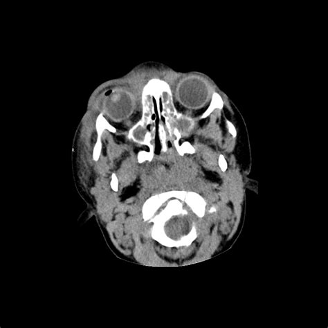 Pediatric Orbital Cellulitis | Pediatric Radiology Reference Article | Pediatric Imaging ...