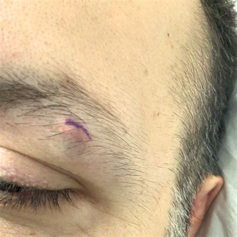 Eyebrow Cyst Removal | Pilomatrixoma Excision & Treatment