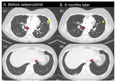 Initial Experiences of Selective RET Inhibitor Selpercatinib in Adults ...
