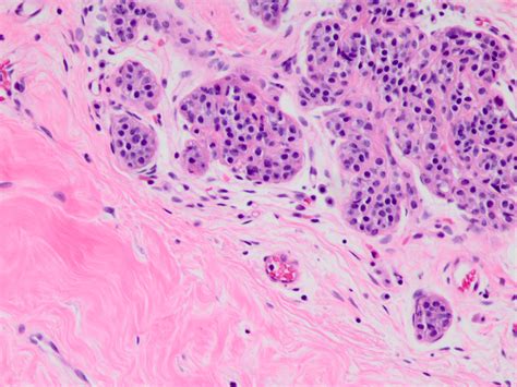 Pathology Outlines - Atypical lobular hyperplasia