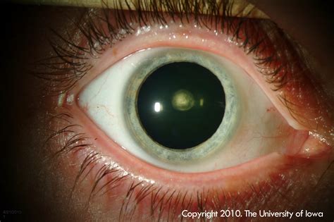 Posterior Polar Cataract. EyeRounds.org - Ophthalmology - The ...