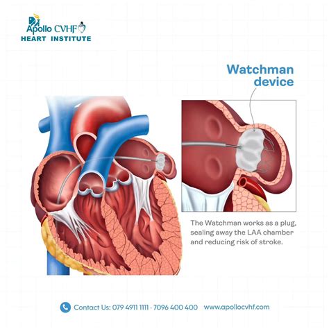 What is Watchman’s device? | Apollo CVHF Heart Institute