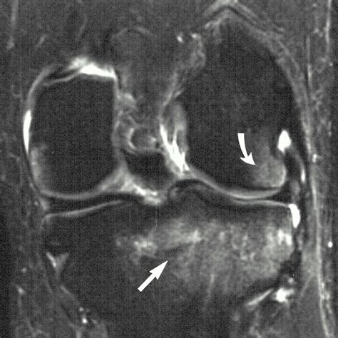 Bone Contusion Patterns of the Knee at MR Imaging: Footprint of the Mechanism of Injury ...