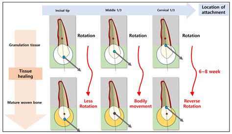 The Center of Resistance of an Impacted Maxillary Canine: A Finite ...