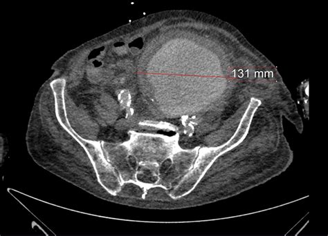 The Interrupted Natural History of Aortic and Iliac Artery Aneurysms ...