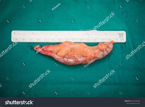 Patient asian appendectomy 44 รายการ ภาพ ภาพสต็อกและเวกเตอร์ | Shutterstock