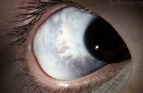 Eye Conjunctiva Sclera