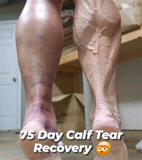 How To Heal A Calf Tear Quickly