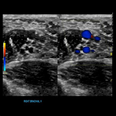 Upper Extremity Venous Doppler – Sonographic Tendencies | Vascular ultrasound, Diagnostic ...
