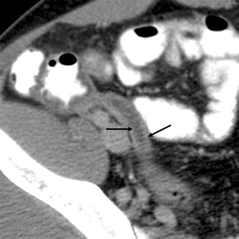CT Evaluation of Appendicitis and Its Complications: Imaging Techniques and Key Diagnostic ...