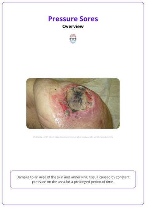 Pressure Sores: Causes, Clinical Assessment, & Management