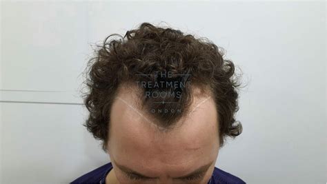 Widows Peak Haircuts Men