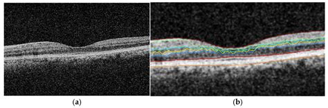 Retinal OCT Images: Graph-Based Layer Segmentation and Clinical Validation