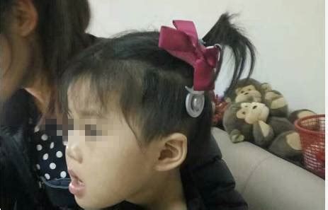人工耳蜗丢失30多小时失而复得_ 视频中国