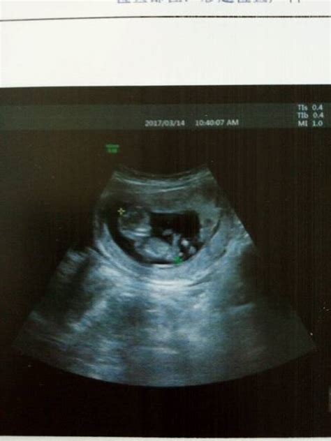 孕12周胎儿小鸡彩超图解，两腿之间有凸起就稳了 - 姐妹邦