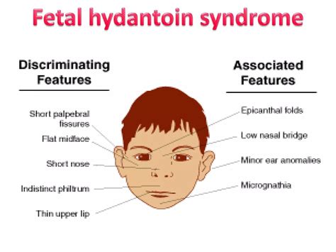 Fetal Hydantoin Syndrome