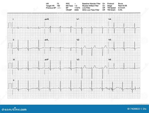 EKG Or ECG Result From A Treadmill Stress Test Stock Photo | CartoonDealer.com #7428822