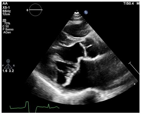 Interesting Facts About Mitral Valve Prolapse - Infoupdate.org