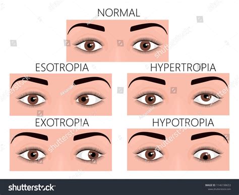 Image result for Normal Human Eye