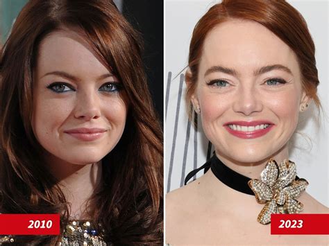 Emma Stone Face Surgery