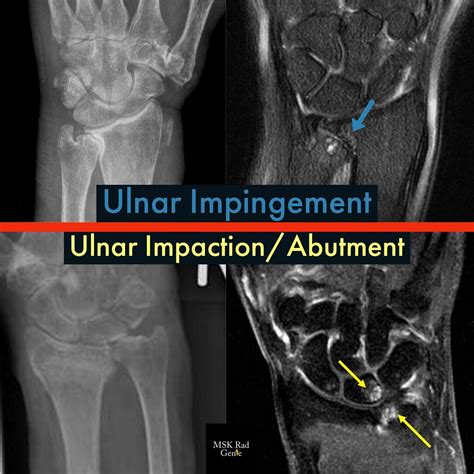 Ulnar Abutment Syndrome