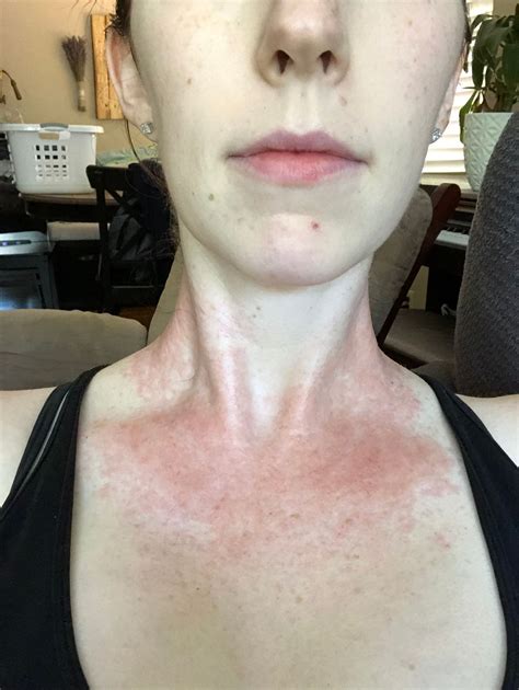Eczema In Pregnancy