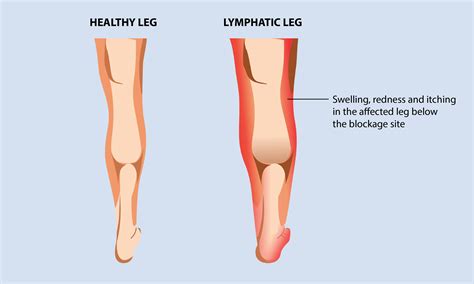 Lymphedema - Causes, Symptoms, Treatment | HEAVYLEGS.IN