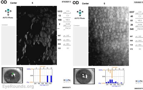 Fuchs’ Endothelial Corneal Dystrophy