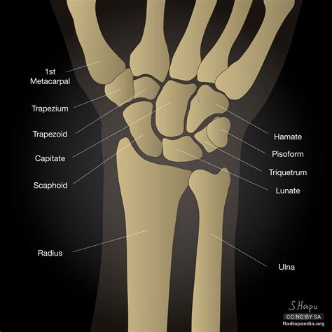 Carpal Bone Anatomy Wrist Joint Replacement (Wrist Arthroplasty)