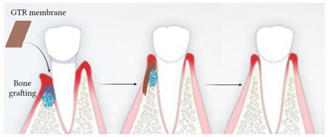 Recent Advances in Functionalized Electrospun Membranes for Periodontal ...