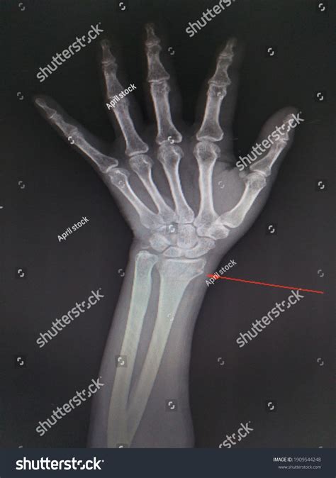 Ulnar Styloid Process Fracture