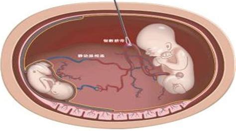 有没有可能两个精子同时进入一个卵细胞（包括特殊情况）？同卵双生什么情况下是异性？ - 知乎