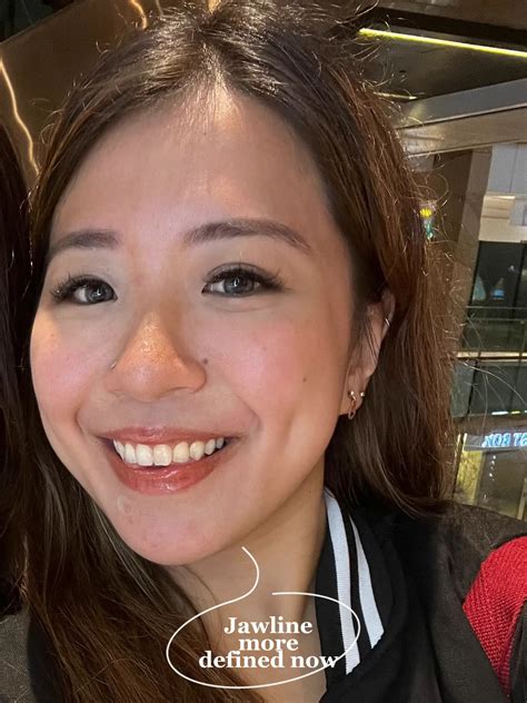 Achieved my V shape face without surgery at $108! | แกลเลอรีที่โพสต์โดย Cherie 🍒 | Lemon8