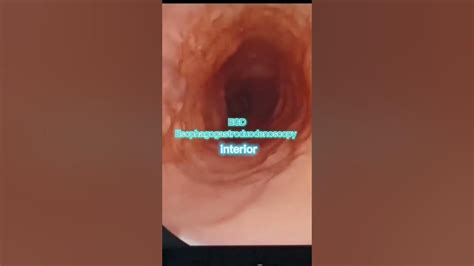 Image result for EDG Procedures