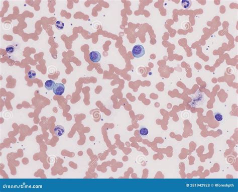 Plasma cell leukemia. stock photo. Image of cells, laboratory - 281942928