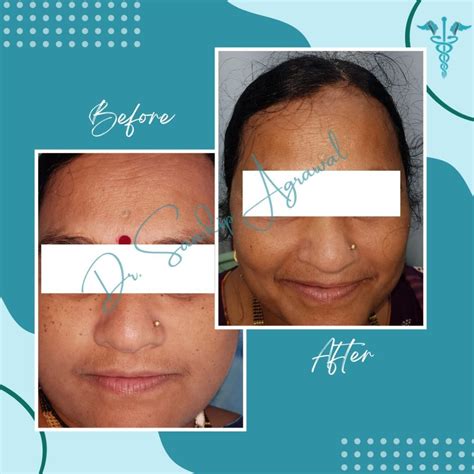 Treatment Gallery - Dr. Sandip Agrawal