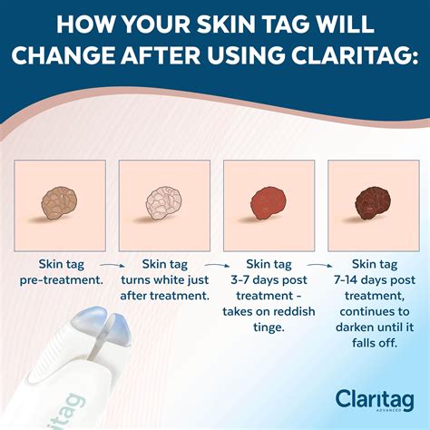 Advanced Skin Tag Remover - FDA-Cleared Device - Only for Skin Tag ...