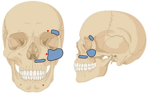 Off-Label Treatment for Severe Craniomaxillofacial Fractures in Low ...